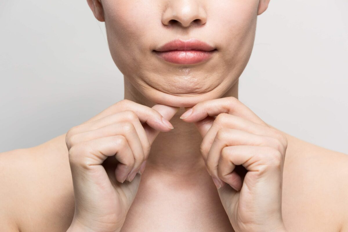 How Kybella Can Help Eliminate Double Chin Fat? 3 A Female holding her fat cheeks | Kybella in Scottsdale, AZ | Skyler Soares Skin Clinic