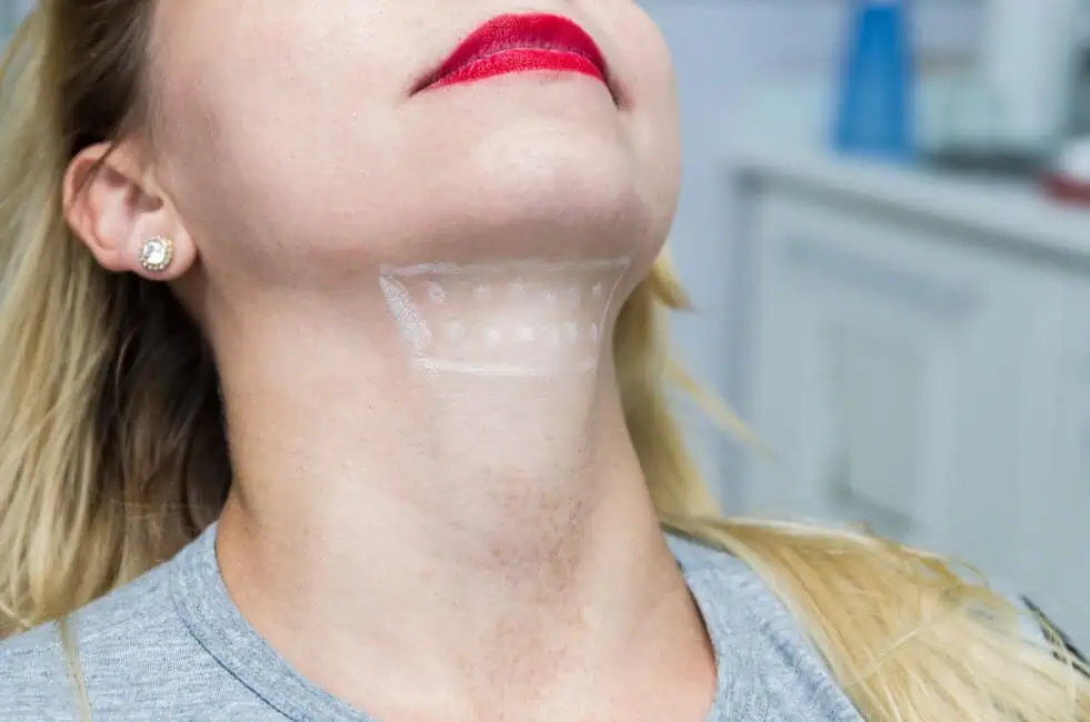 Woman receiving Kybella treatment on her neck for chin contouring.