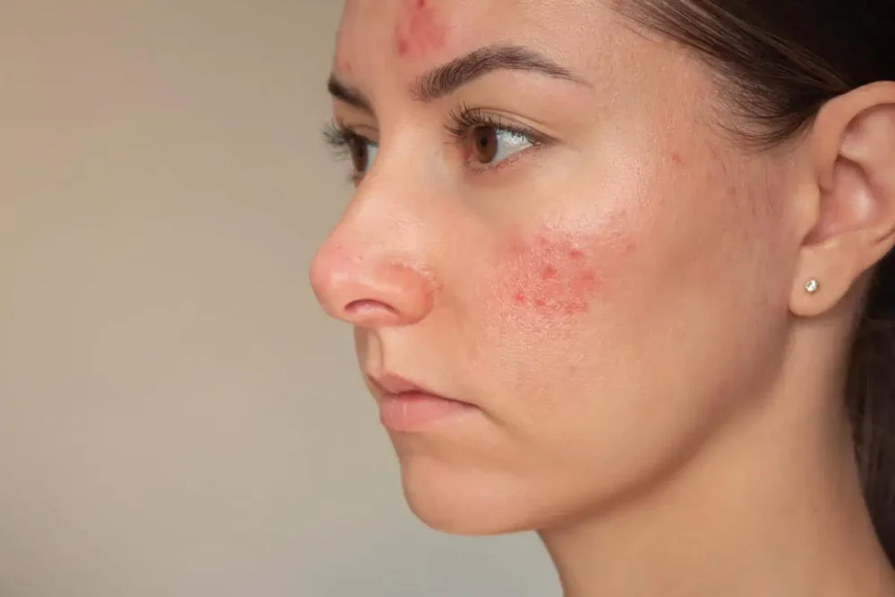 Close-up of woman receiving BBL Hero laser treatment for skin tone correction at a Scottsdale med spa | Skyler Soares